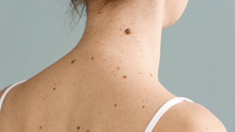Skin Cancer Screening Near Merrifield, VA